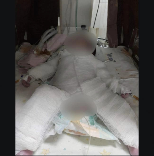 Такою Клавдія побачила свою дочку після операції. Все тільце дитини було в бинтах